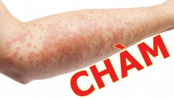 Cách trị chàm hiệu quả nhất từ nguyên liệu thiên nhiên
