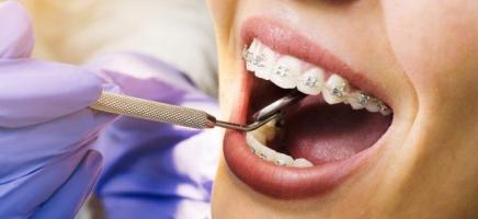 Địa chỉ niềng răng uy tín, chất lượng nhất tại Bình Dương
