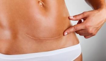 Điều cần biết khi sinh mổ bà bầu nên chú ý