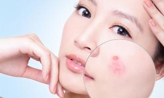 Thói quen hàng ngày khiến da bạn nổi mụn