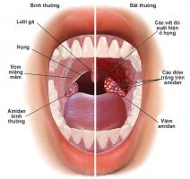 Thực phẩm chức năng hỗ trợ điều trị viêm họng tốt nhất hiện nay