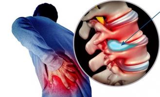 Thực phẩm chức năng tốt nhất cho người thoát vị đĩa đệm