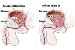 Viên uống hỗ trợ điều trị u xơ tiền liệt tuyến hiệu quả nhất hiện nay